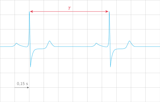 ../../_images/Electrocardiogramme.jpg